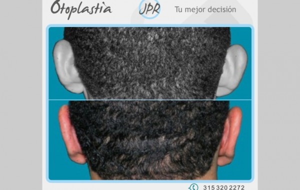 Caso 93